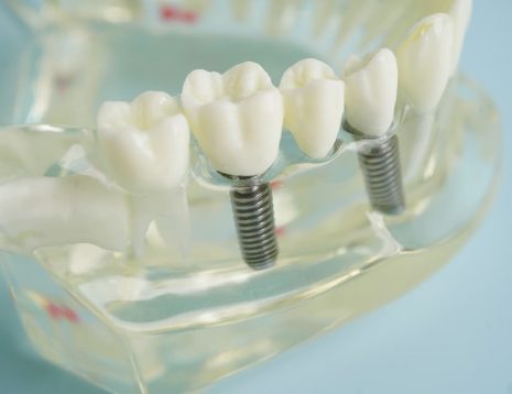 How to Tell If Your Dental Implant Is Failing