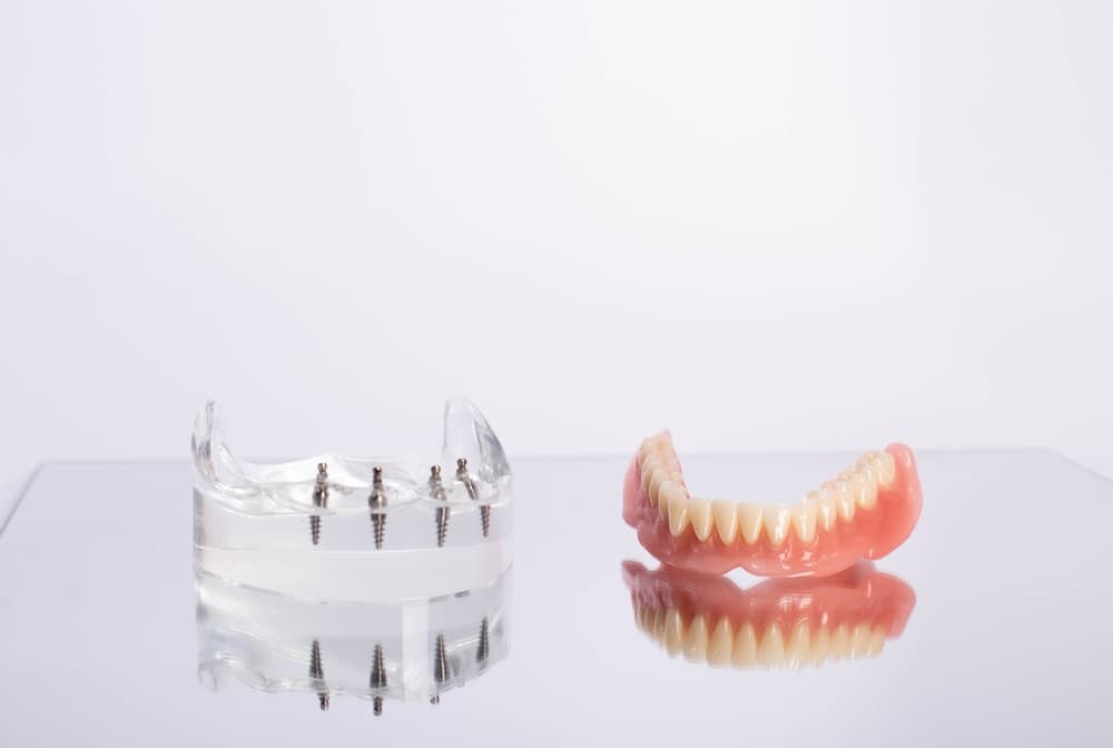 Dental Implants vs Removable Prosthetics