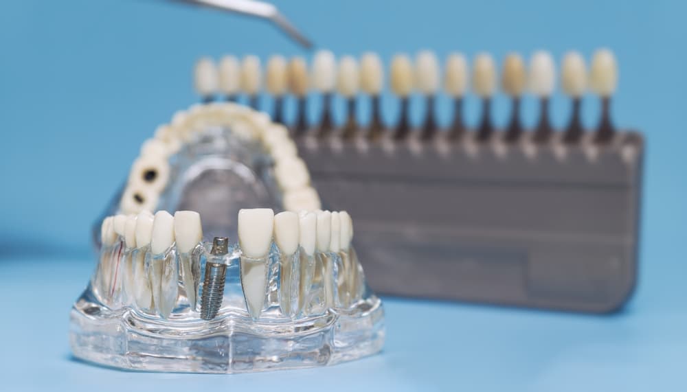 Dental Implants